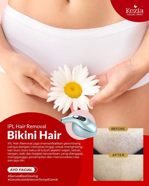 IPL hair removal bikini hair