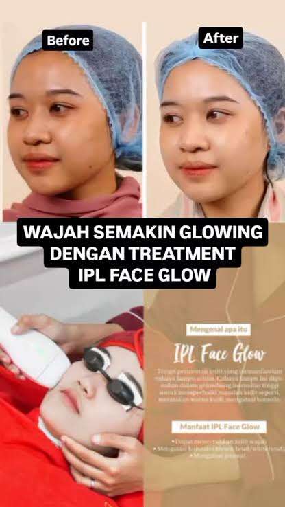 IPL face glow