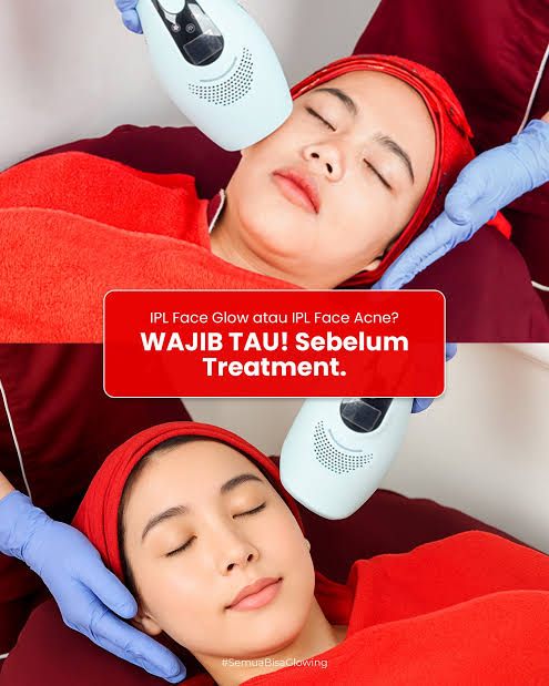 IPL face Acne + facial whitening