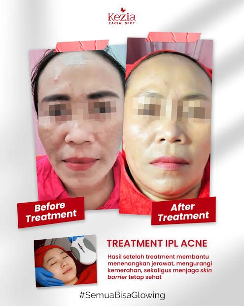 IPL face acne